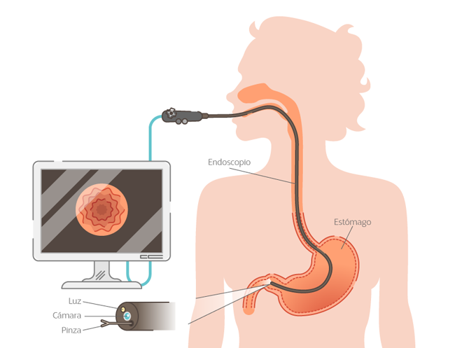 Con la endoscopia gastrointestinal se obtienen imgenes de alta resolucin para diagnsticos acertados